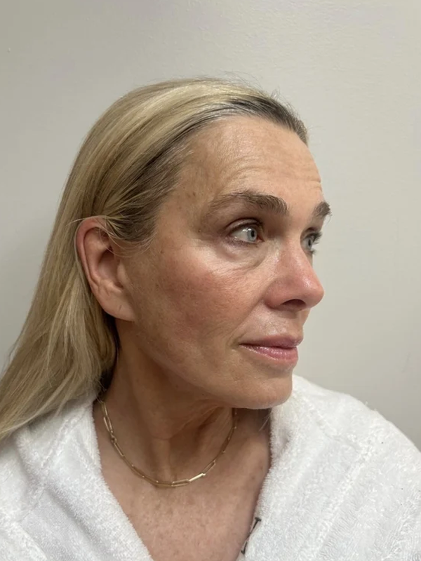 After one 50-minute KPS facial
