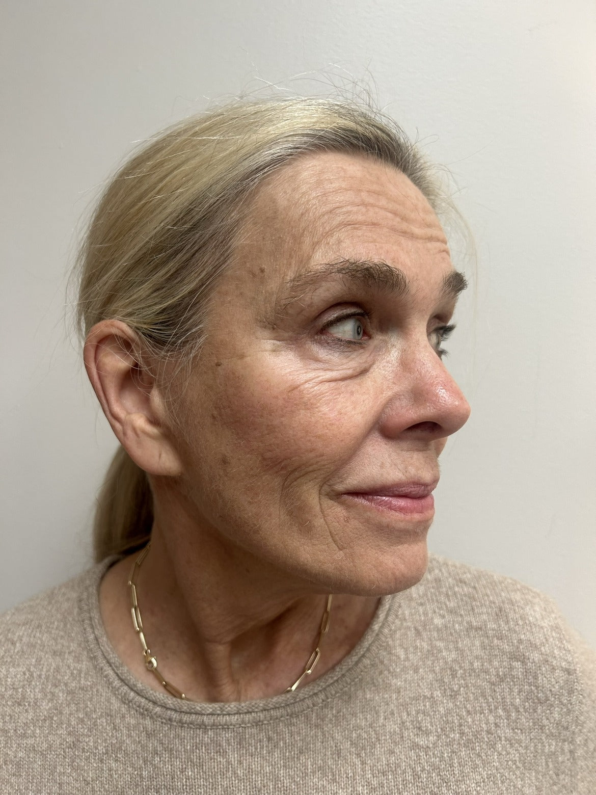 Before one 50-minute KPS facial